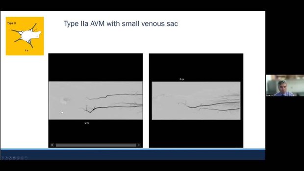 How to Use Coils and Plugs for AVM Embolization | Vumedi