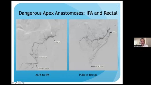 Prostate Arterial Anatomy and Collaterals: Essentials | Vumedi