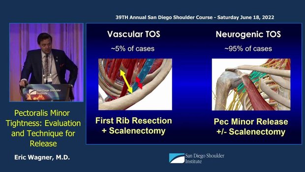 Pectoralis Minor Tightness and TOS: Evaluation and Arthroscopic ...