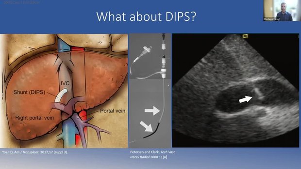 Basics of IVUS Guidance in TIPS and DIPS | Vumedi