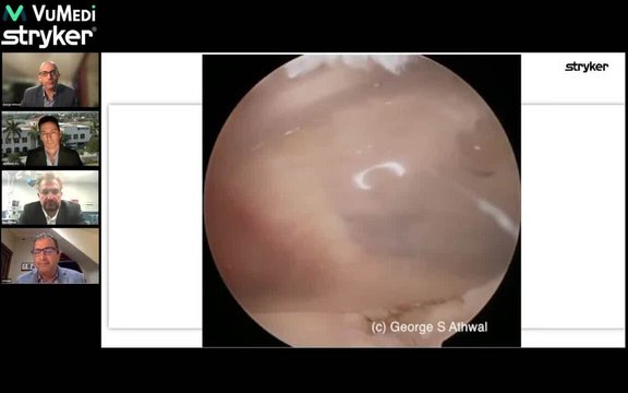 Subacromial Balloon Spacer Surgical Technique and Case Study | Vumedi