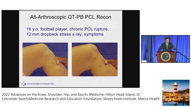Diagnosis and Treatment of PCL and Posterolateral Ligament Injuries ...