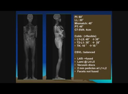Case Presentation: L1-L4 OLIF and L5-S1 Lateral ALIF | Vumedi