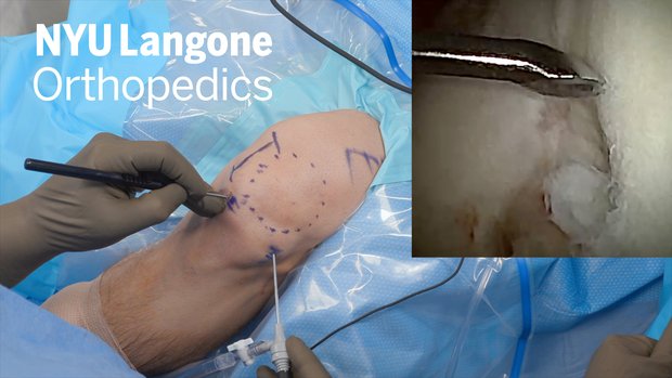 Cartilage Biopsy for Autologous Cell-based Repair of the Knee in the  Wide-Awake Setting Using Needle Arthroscopy