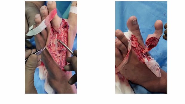 Microvascular Toe Transfer to Hand | Vumedi