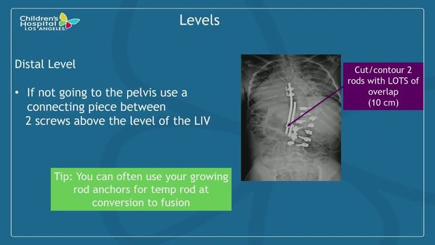 Temporary Internal Distraction Rods for Severe Scoliosis | Vumedi