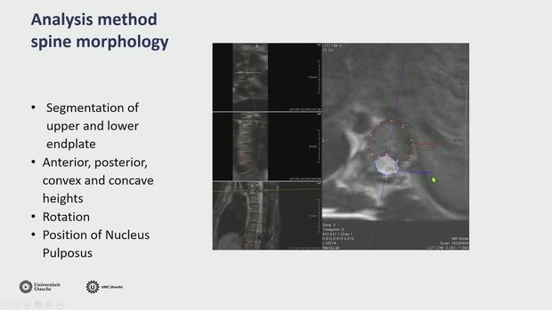 3D Changes in Spine Morphology After Spring Distraction System (SDS ...
