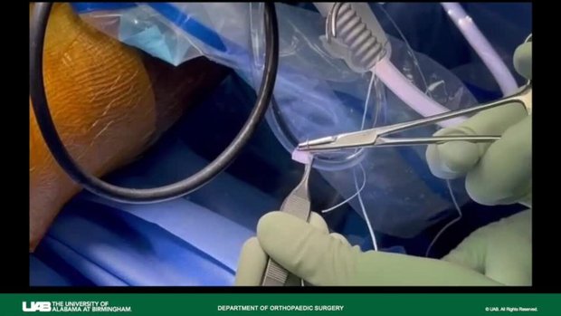bpc 157 for meniscus Meniscus Repair Augmented with BioBrace