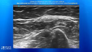 Lipoma Pressing on the Ulnar Nerve in a 38 Year Old Female Causing a ...