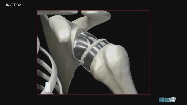 Biomechanics: Shoulder Prosthesis | Vumedi