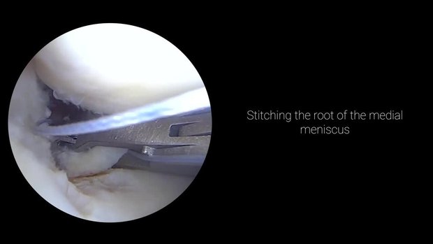 Medial Meniscus Root Repair | Vumedi