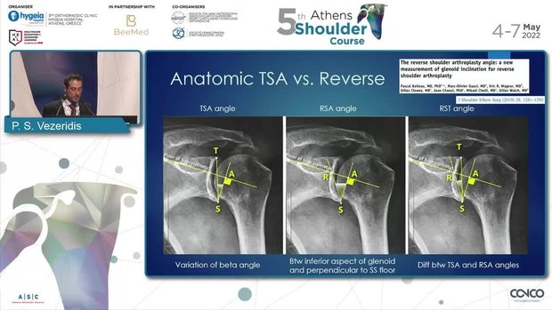 Reverse Shoulder Arthroplasty: What Measurements Do You Need ...