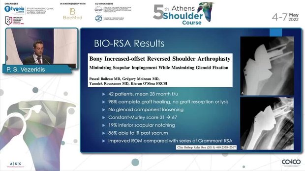 Lateralization From the Glenoid: The BIO - RSA | Vumedi