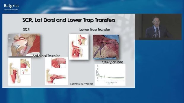 Treatment of Massive, Irreparable RCT: SCR vs LTT vs LD | Vumedi