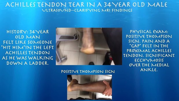 bpc 157 for achilles tendonitis The 