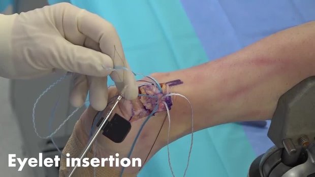 Double Row Achilles Tendon Attachment Following Retrocalcaneal ...