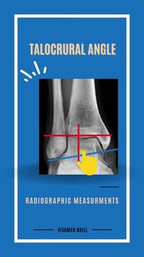 Malleolar ankle fractures radiographic evaluation part 2 | Vumedi