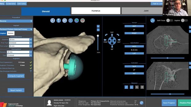 Shoulder iD Primary Reversed Glenoid webinar - February 2023 | Vumedi