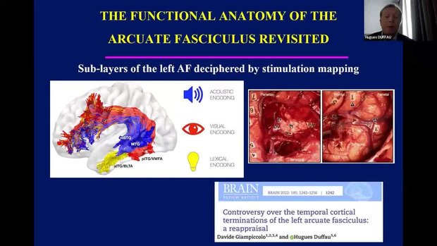 Awake Surgery With Cognitive Mapping for Low-Grade Gliomas: a ...