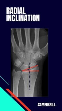 Distal radius fractures parameters part 2 Radial inclination | Vumedi