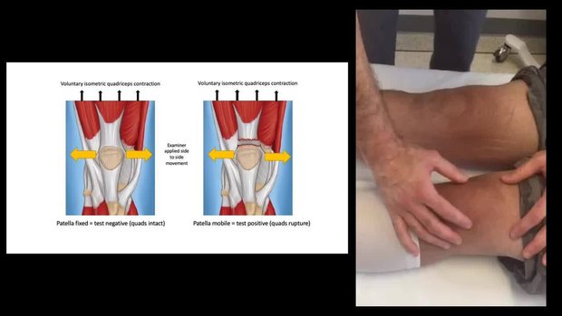 The Fixed Patella Test for the Clinical Evaluation of Quadriceps Tendon  Rupture