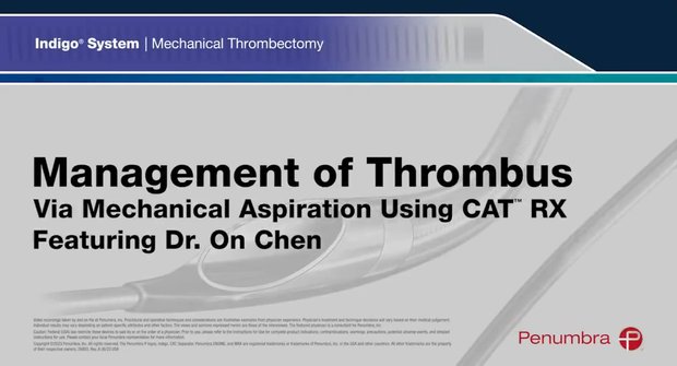 Management of Thrombus via Mechanical Aspiration Using CAT RX | Vumedi