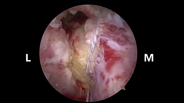 Endoscopic Hamstring Repair Of Full Thickness Retracted Tears | Vumedi