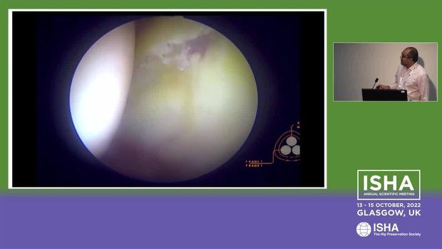 AMIC Labral Reconstruction / Augmentation | Vumedi