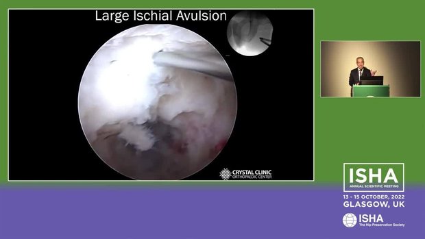 Hamstrings Rupture and Avulsion: When to Repair and How | Vumedi