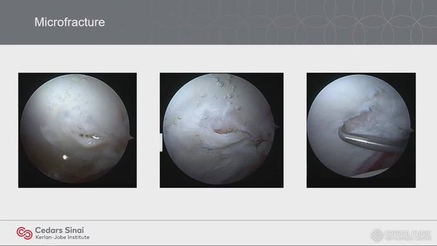 Chondroplasty, Microfracture, Matrix Augmented Cartilage Restoration ...