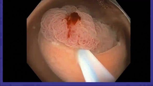Underwater EMR (Polypectomy: This Is How I Do It) | Vumedi
