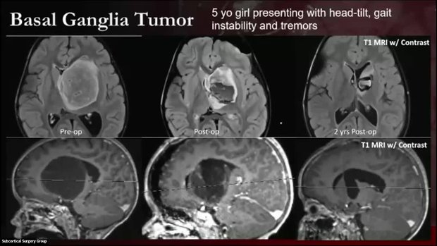 BrainPath Exoscope Use in Pediatric Neurosurgery: Outcomes & Novel Uses ...