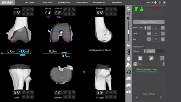 Robotic-arm assisted TKA: An overview of the new Mako Total Knee 2.0 ...