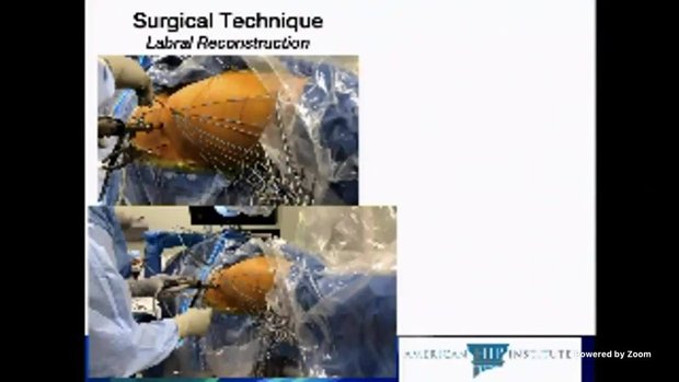 Circumferential Labral Reconstruction for Irreparable Labral Tears in ...