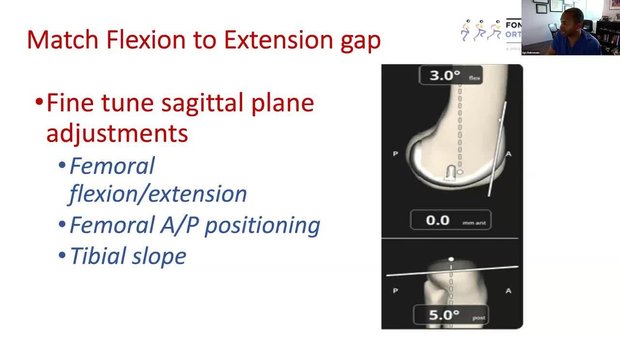 Robotic-Assisted Total Knee Arthroplasty Balancing 101: Transitioning ...