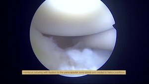 Discoid lateral meniscus tear - partial resection and suturing with a ...