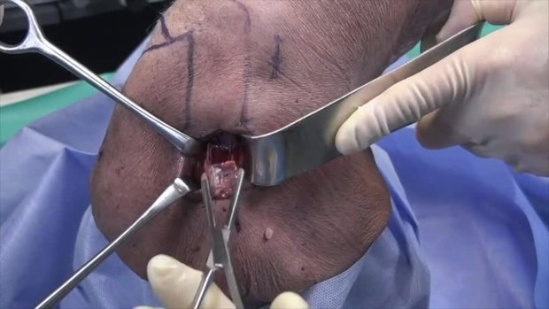 Arthroscopic Bone Block Cerclage Technique Using a Tricortical Scapular ...