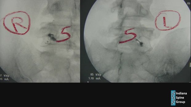 Direct Pars Repair for L5 Spondylolysis in the Athlete | Vumedi