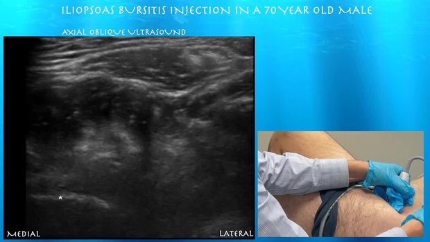 Iliopsoas Bursitis Injection in a 70 Year Old Male | Vumedi