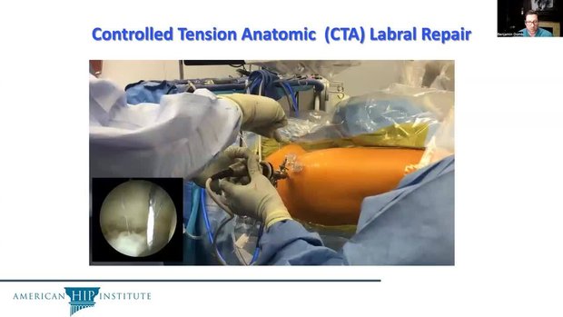 Labral Repair: When and How | Vumedi