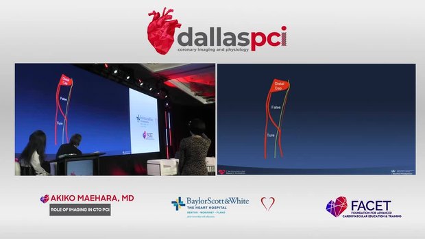 Role of Imaging in CTO PCI | Vumedi
