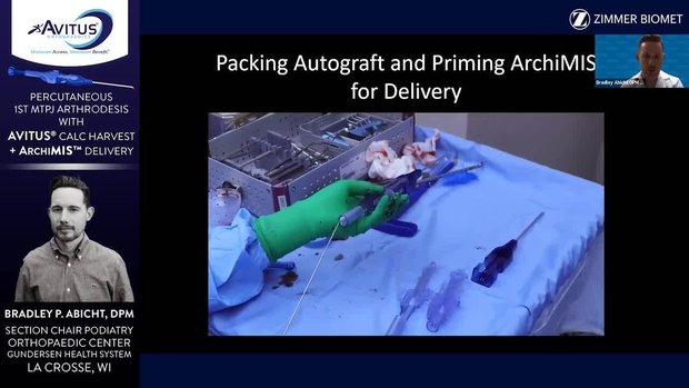Percutaneous MPJ Fusion with Avitus Calcaneus Bone Graft Delivered with ...