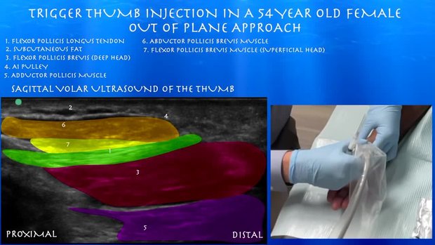 Trigger Thumb Injection in 54 Year Old Female Out of Plane Approach ...