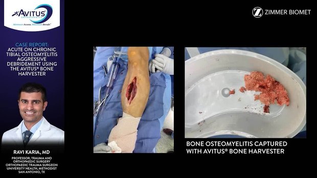 Chronic Tibial Osteomyelitis Debridement with Avitus Bone Harvester ...