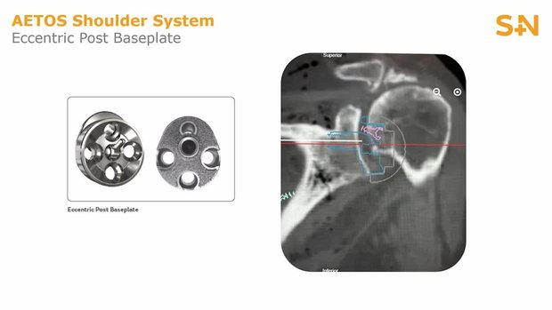 Baseplate Selection in Shoulder Arthroplasty: Understanding the Options ...