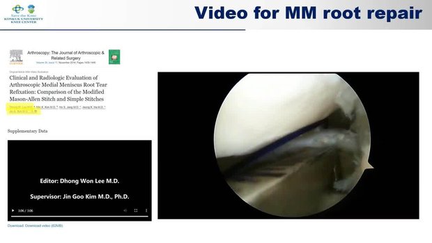 Korean Trends in Medial Meniscus Root Repair and Reconstruction | Vumedi