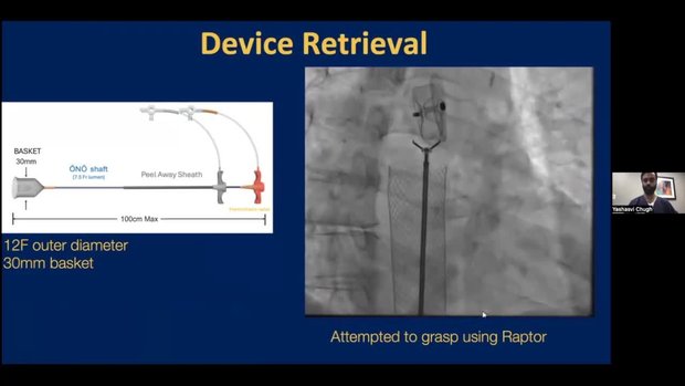 TCT 2024 Insights: Percutaneous Retrieval of an Embolized Amulet Device ...