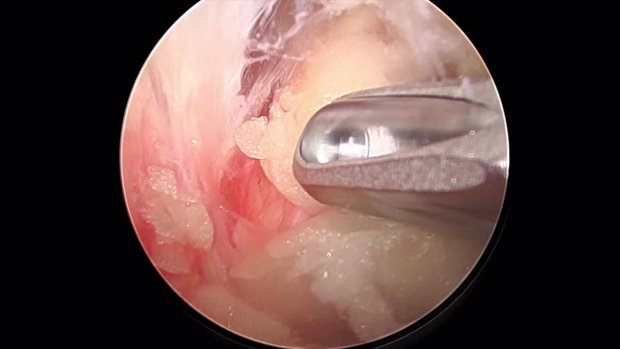 Arthroscopic Suprascapular Nerve Decompression | Vumedi