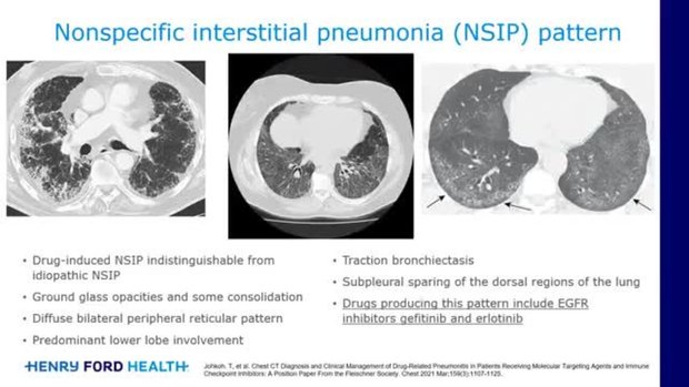 Drug Induced Interstitial Lung Disease in Lung Cancer | Vumedi
