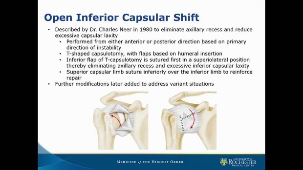 Multidirectional Shoulder Instability | Vumedi